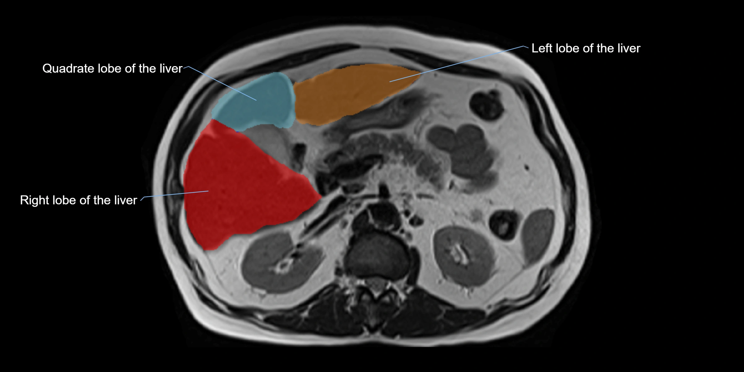MRI liver lobe axial cross sectional 3T radiology  image-img-00001-00018.webp
